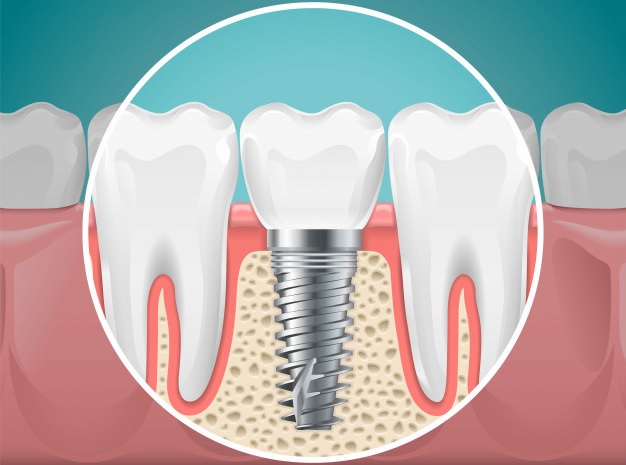 Implantes