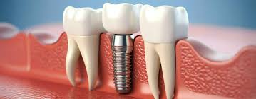 Implantes Dentales